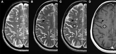 Opportunities and Obstacles Associated With Sequential Immune Reconstitution Therapy for Multiple Sclerosis: A Case Report